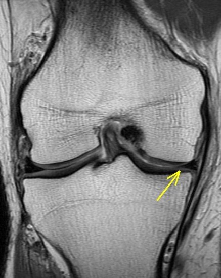 Figure 2 for case Unstable displaced medial meniscus tear( RID2772 ) with reactive tibial edema